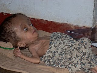 Child affected by Endosulfan